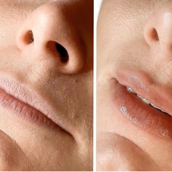 Distinctive Lashes & Beauty - Hyaluronic Acid Needle Free Lip Fillers - Eyelash Service Near Me - Smyrna, Georgia Distinctive Lashes & Beauty - Hyaluronic Acid Needle Free Lip Fillers - Eyelash Service Near Me - Smyrna, Georgia
