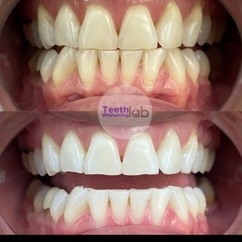 Teeth Whitening Lab  - Before and after picture! - Teeth Whitening Near Me - Long Beach, California