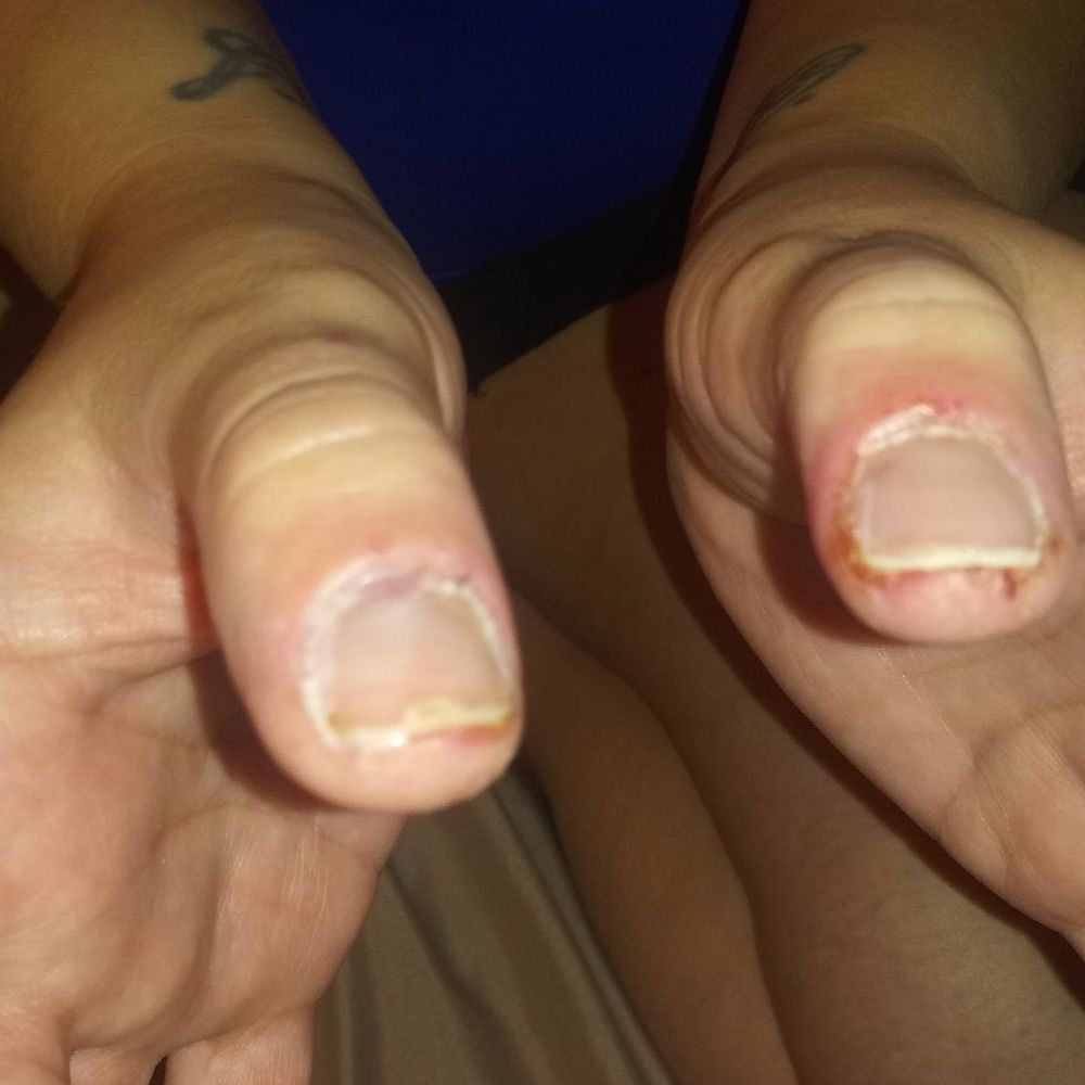 Herbal Nails & Spa In Mesa-Gilbert - THUMBS RAW, SPLIT AND ON FIRE! - Nail Salons Near Me - Gilbert, Arizona