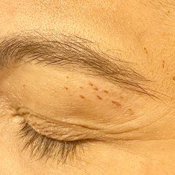 Beauty by Thread - Left eyelid and above my eyebrow - two days later.