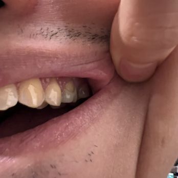 All In One Dental Innovations - Beware of bad crowning that ends up cracking within 4 years. - Cosmetic Dentists Near Me - Dublin, California All In One Dental Innovations - Beware of bad crowning that ends up cracking within 4 years. - Cosmetic Dentists Near Me - Dublin, California