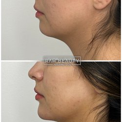 Raw Beauty Aesthetics - Chin Filler with Neck Slimming