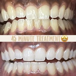 Smiles By Vaeh - 45 minute first time teeth whitening treatment