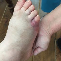 SQ Specialties - My sister's foot. Broken by blunt force trauma and finger print bruising on her legs where someone grabbed her