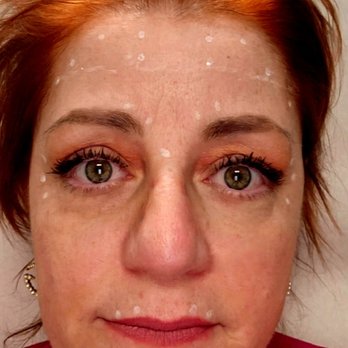 Ideal Image Albany - Pic contrast shows the white dots. I asked 4 forehead. Did I need more? She did 2 much & charged me close to $600!!  Robery - Laser Hair Removal Near Me - Albany, New York