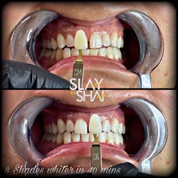 House Of Slay Beauty Bar & Training Academy - Teeth whitening