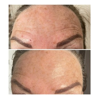 Headlines Tox Bar - 4 days post Botox administration. It takes up to 14 days for full effect, but you can see here the lines/wrinkles are already softening. - Medical Spas Near Me - Saugus, Massachusetts Headlines Tox Bar - 4 days post Botox administration. It takes up to 14 days for full effect, but you can see here the lines/wrinkles are already softening. - Medical Spas Near Me - Saugus, Massachusetts