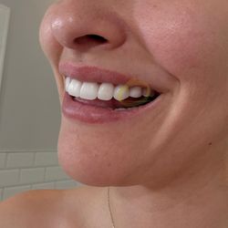 Smile Again Dental - Teeth ended up being squared off, much smaller than the others, and looked completely disproportionate. It was as if no care or attention w