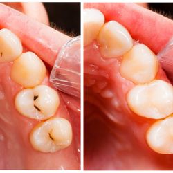 Francis Dental - Composite Fillings (sonicfill)