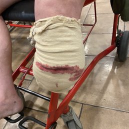 40+ stitches broke loose. Enloe does Nothing 40+ stitches broke loose. Enloe does Nothing