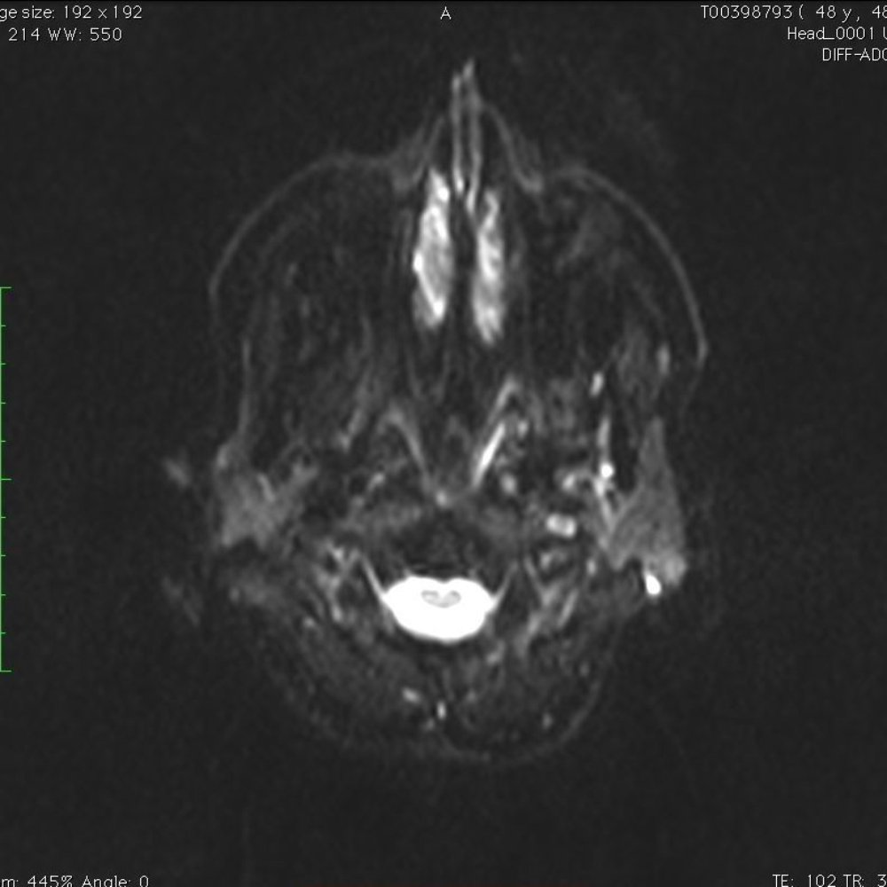 Theresa Keefe, DMD - With the smaller lymphomas, there is a tendency to spread as a diffuse thin sheet of tumor to the nasal cavity and turbinates. - Periodontists Near Me - Canton, Connecticut