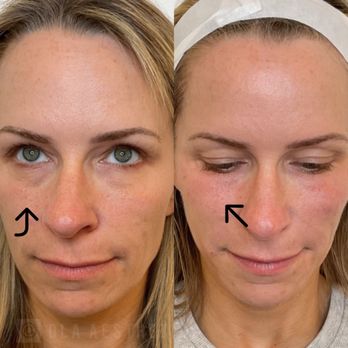 Ola Aesthetics - Derma PRP- our natural volumizer using your own prp! Amazing for under- eye rejuvenation! - Medical Spas Near Me - Los Angeles, California Ola Aesthetics - Derma PRP- our natural volumizer using your own prp! Amazing for under- eye rejuvenation! - Medical Spas Near Me - Los Angeles, California