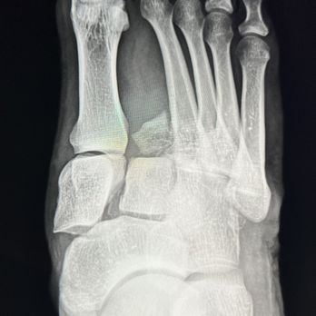 Eugene Curry, M.D. - Severe Lisfranc fracture dislocation in a professional NFL player - Orthopedists Near Me - Dallas, Texas Eugene Curry, M.D. - Severe Lisfranc fracture dislocation in a professional NFL player - Orthopedists Near Me - Dallas, Texas