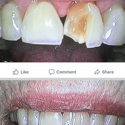 Parish Family Dental - Same day crown fabricated and placed onsite. All ceramic no metal!