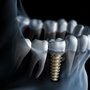 Photo of Peter Glavas,DDS -Ideal Dental Implants