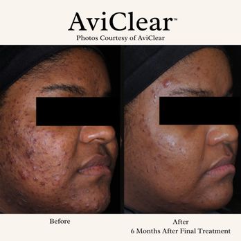 Spa Aesthetica Medical Spa & Wellness Center - AviClear: FDA-cleared laser for mild to severe acne. Targets sebaceous glands, drug-free with no downtime. Effective for all skin types. - Laser Hair Removal Near Me - E Orange, California Spa Aesthetica Medical Spa & Wellness Center - AviClear: FDA-cleared laser for mild to severe acne. Targets sebaceous glands, drug-free with no downtime. Effective for all skin types. - Laser Hair Removal Near Me - E Orange, California