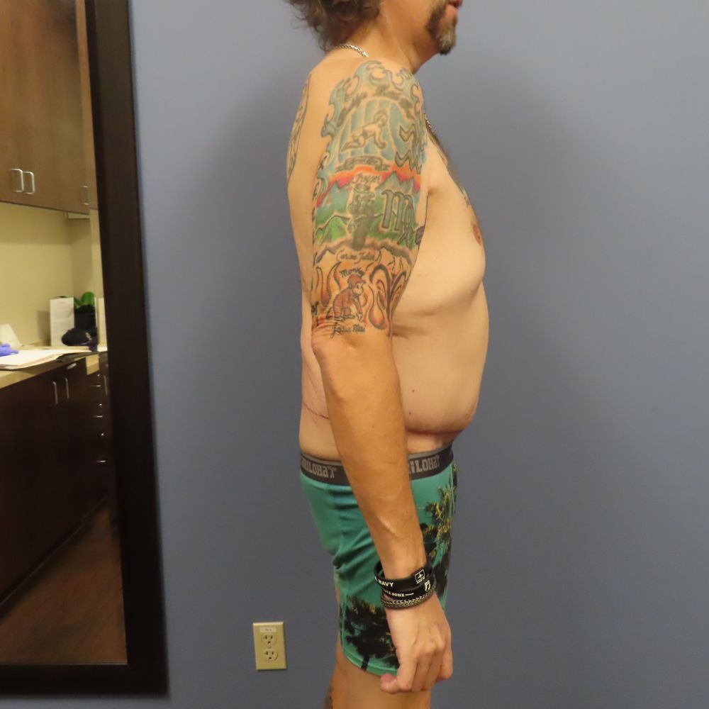 Matthew D Freeman, MD - 5 Weeks Post Op - Plastic Surgeons Near Me - Denver, Colorado