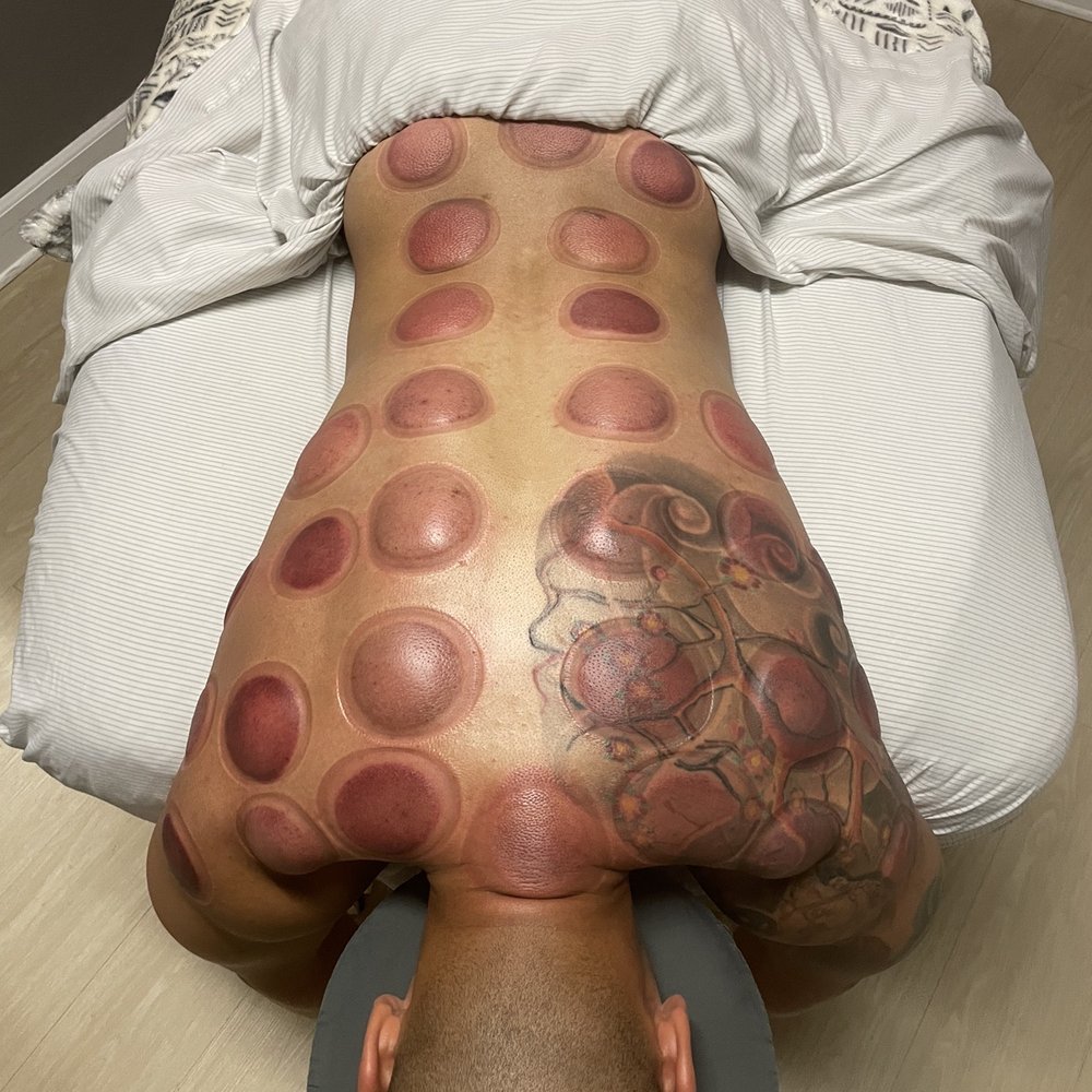 Knotted Up - Post cupping results - Massage Therapy Near Me - Rancho Cucamonga, California Knotted Up - Post cupping results - Massage Therapy Near Me - Rancho Cucamonga, California