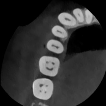 Studio City Endodontics and Microsurgery - Smily face from CT scan - Endodontists Near Me - San Fernando Valley, California Studio City Endodontics and Microsurgery - Smily face from CT scan - Endodontists Near Me - San Fernando Valley, California