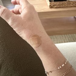 orthocarolina - Marla gave me a shot two weeks later NOT in my artery that worked wonders.
