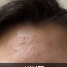 My skin after the facials and some dosha products My skin after the facials and some dosha products