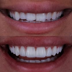 Dr. Rowan Vilar Dentista em Ipanema Rio de Janeiro - Before and After - Dental Composite Resin Veneers