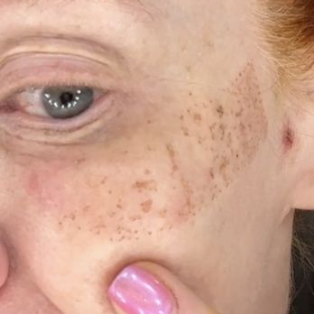 Jilan Wise Aesthetics - Day 6 - Skin Care Near Me - Henderson, Nevada