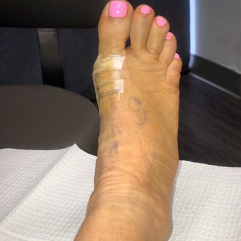 Empire Foot and Ankle Center - 11 days post op - Podiatrists Near Me - Upland, California