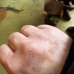 Saltspring Soapworks - This was my hand the day after the cracked skin was healing finally