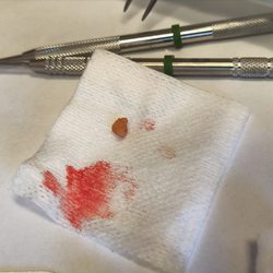Elgin Oral And Maxillofacial Surgery - The tooth that was left behind that my dentist had to remove.