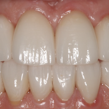 Maple Drive Dentistry - After - General Dentistry Near Me - Atlanta, Georgia Maple Drive Dentistry - After - General Dentistry Near Me - Atlanta, Georgia