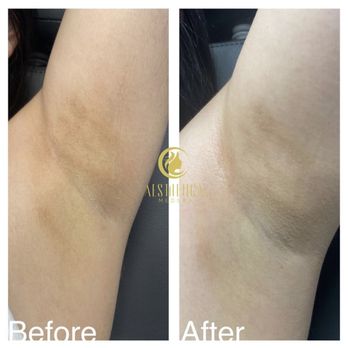 Aesthetica MedSpa - Intimate bleaching before and after - Medical Spas Near Me - Paramus, New Jersey Aesthetica MedSpa - Intimate bleaching before and after - Medical Spas Near Me - Paramus, New Jersey