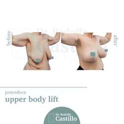 My Best Body Ever! - Upper Body Lift