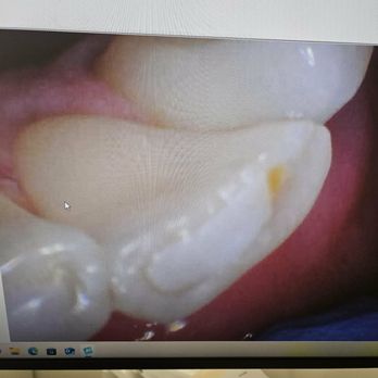 Seza Barsamian, DDS - Cavity shown on a front tooth - Cosmetic Dentists Near Me - Los Alamitos, California