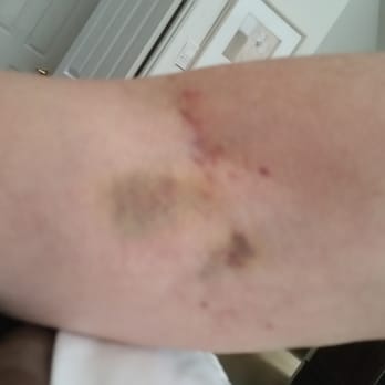 EvergreenHealth Monroe - Compliments of the ER. Over a dozen attempts to get an IV in the arm. - Hospitals Near Me - Monroe, Washington
