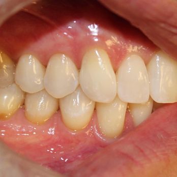 Bon DDS Dental Studio - Second treatment - Cosmetic Dentists Near Me - St. Charles, Illinois