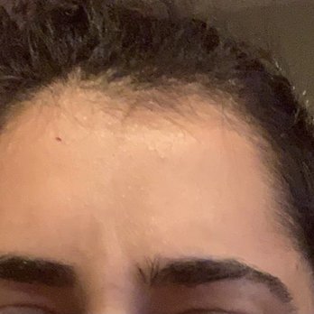 Homayoun Attaran, MD - After: also no crease from furrowing my brows - Cosmetic Surgeons Near Me - San Leandro, California