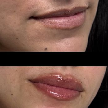 Esthetics Center - Lip filler - Cosmetic Surgeons Near Me - El Dorado Hills, California