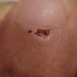 Manicurist removed skin and causes bleeding and scabbing