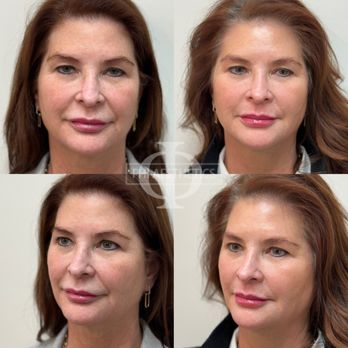 Phi Aesthetics - Before and 6 weeks post PDO threads - Aestheticians Near Me - Franklin, Tennessee