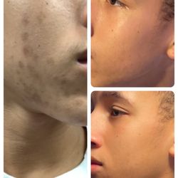 Pigmentation