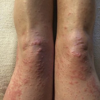 Integrative Health Centre - the rash I developed after seeing Chantelle - Traditional Chinese Medicine Near Me - Calgary, Alberta Integrative Health Centre - the rash I developed after seeing Chantelle - Traditional Chinese Medicine Near Me - Calgary, Alberta