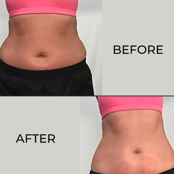 Precise Micro Beauty - Body Contouring - Skin Care Near Me - Clinton Township, Michigan Precise Micro Beauty - Body Contouring - Skin Care Near Me - Clinton Township, Michigan