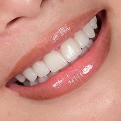 Orange and Magnolia Dental Studio - 10 custom feldspathic porcelain veneers by Dr. Joyce Kahng