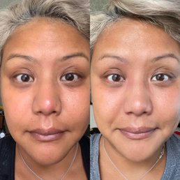 Left - Before Right - 1 week after facial and skin regimen Left - Before Right - 1 week after facial and skin regimen