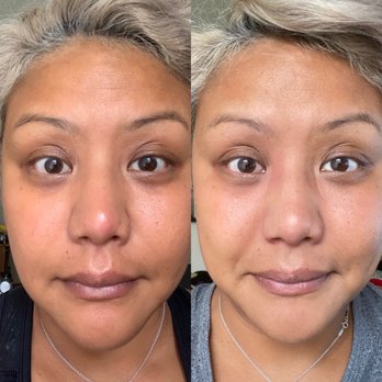 Skin by Lisa - Left - Before Right - 1 week after facial and skin regimen - Skin Care Near Me - San Francisco, California Skin by Lisa - Left - Before Right - 1 week after facial and skin regimen - Skin Care Near Me - San Francisco, California