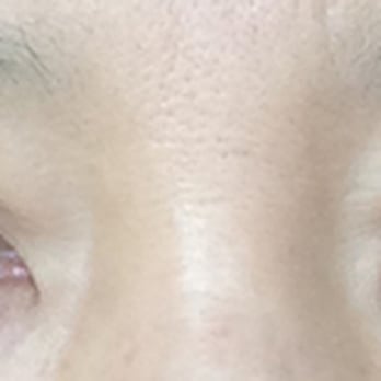 Aesthetic KS - Notice how the upper eyelids are flipped up revealing the underside. Both photos 6 months after surgery. - Cosmetic Surgeons Near Me - Los Angeles, California Aesthetic KS - Notice how the upper eyelids are flipped up revealing the underside. Both photos 6 months after surgery. - Cosmetic Surgeons Near Me - Los Angeles, California