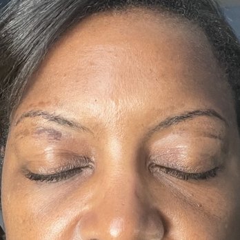 Noire the Nail Bar - Skin bruised and torn on eyebrows. - Nail Salons Near Me - Raleigh, North Carolina