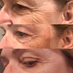 HAZY Brows & Lashes - Before/ during / after plasma fibroblast treatment, amazing results!