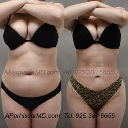 Afshin Parhiscar, MD - 360 Liposuction